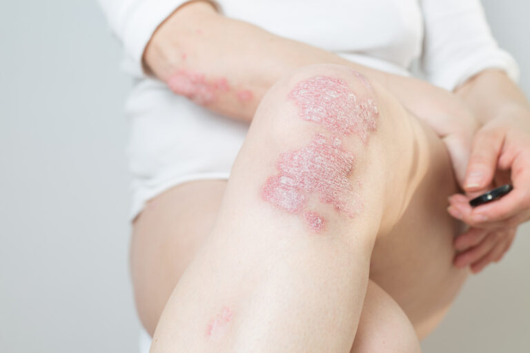 Iniciativa para derribar los mitos sobre la psoriasis
